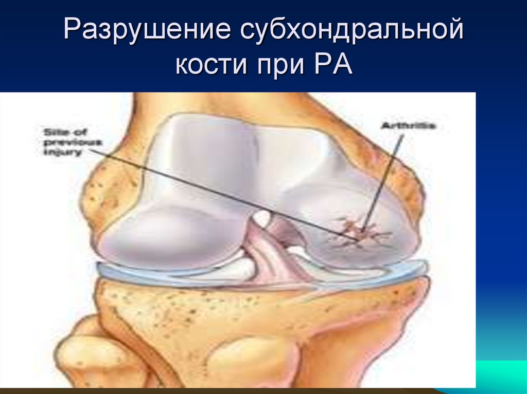 Субхондральную костную ткань