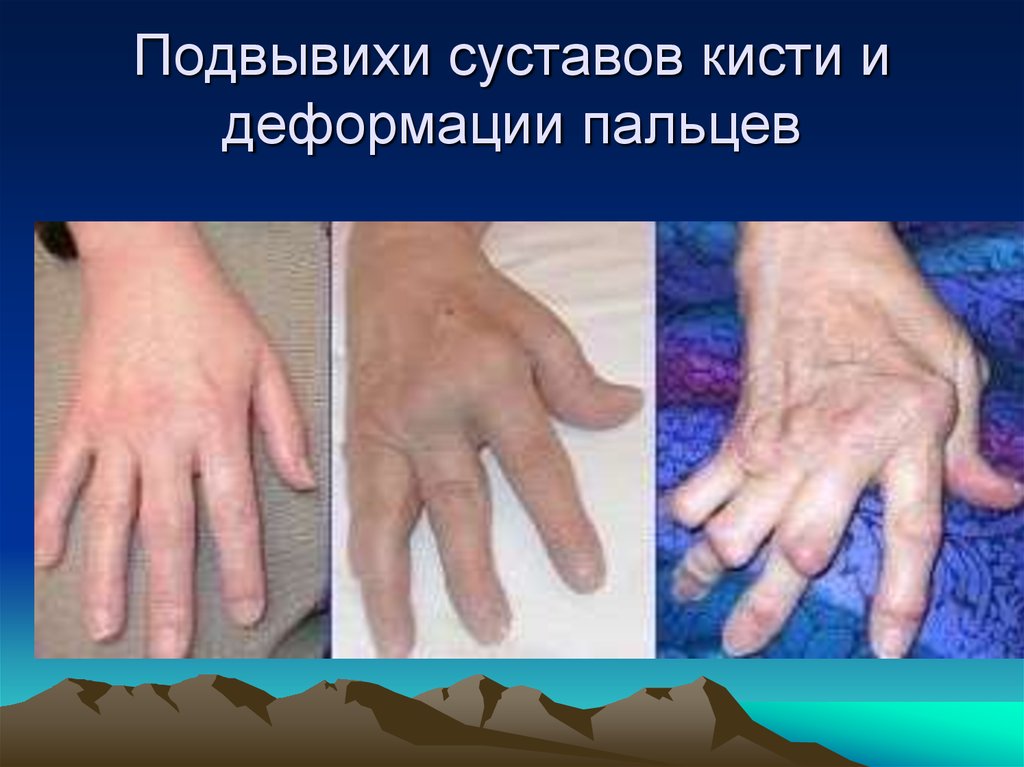 Подвывихи суставов кисти и деформации пальцев