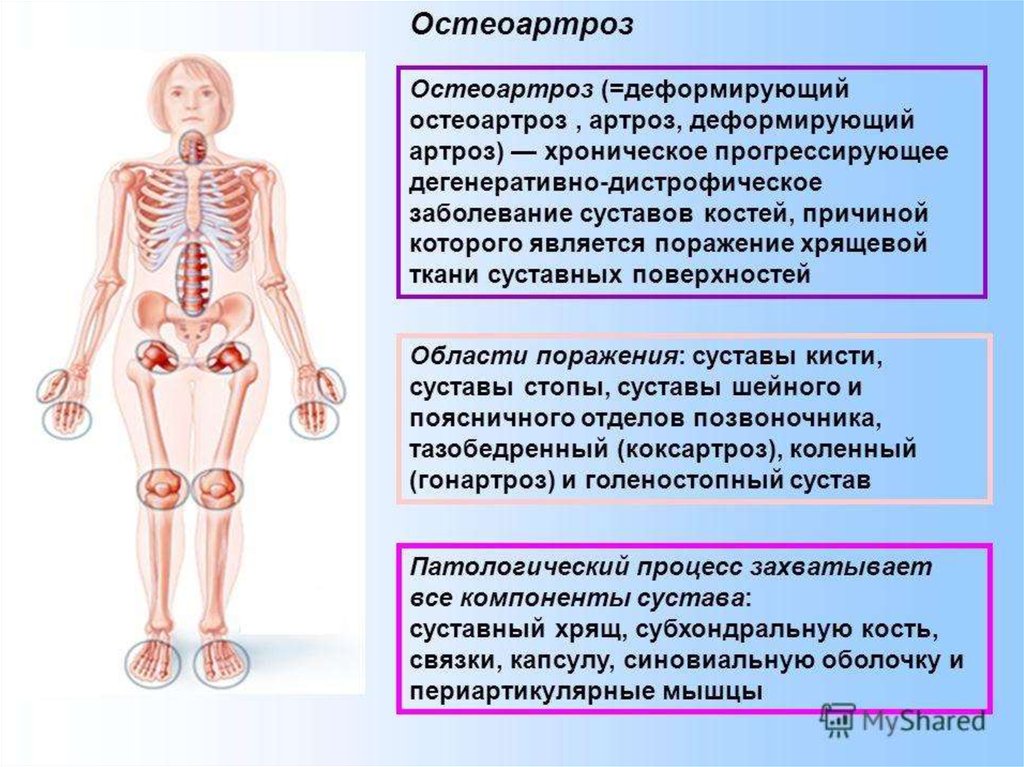 Лечение остеоартроза презентация