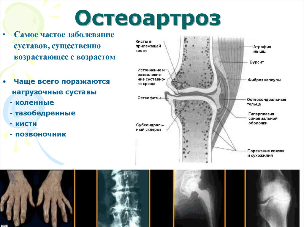 Лечение остеоартроза презентация