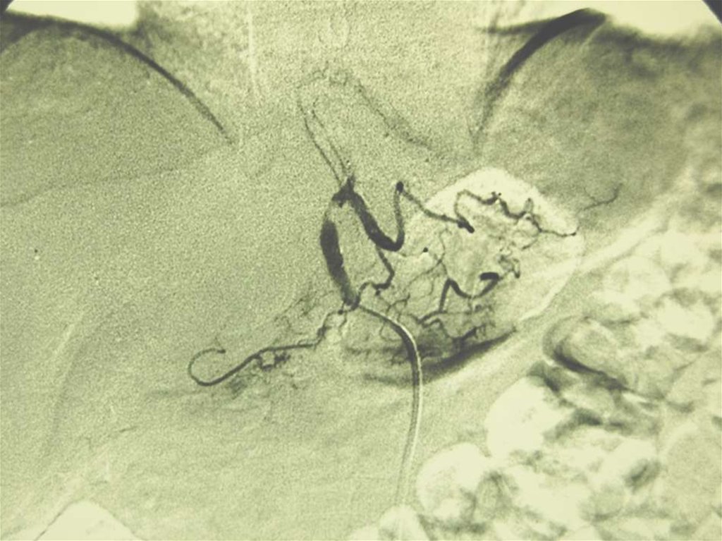 Эмболизация ЛЖА при злокачественном новообразовании желудка