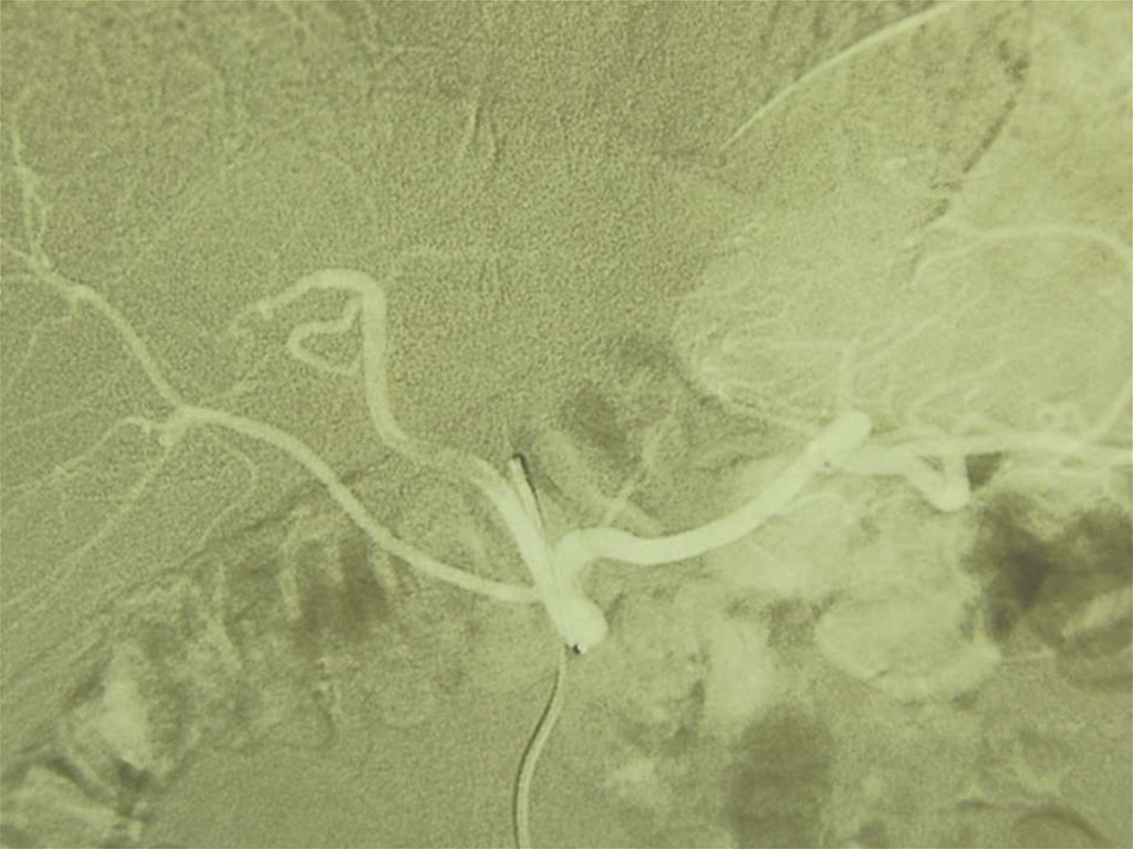 Эмболизация ЛЖА у больного с кровотечением при язве желудка