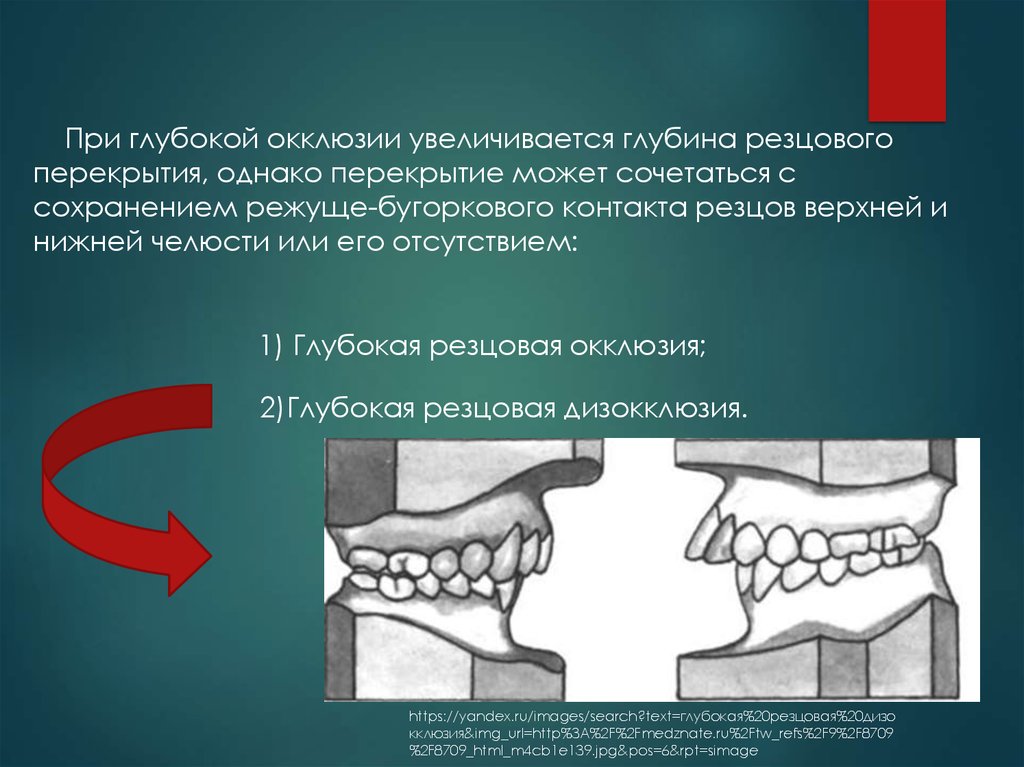 Центральная окклюзия и центральное соотношение. Глубокая резцовая окклюзия и дизокклюзия. Глубокаярезовая окклюзия. Глубокое резцовое перекрытие и глубокий прикус.