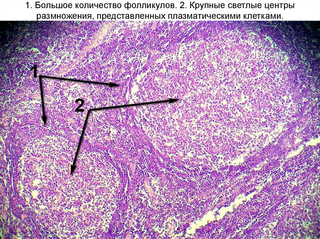 Гиперплазия селезенки. Гиперплазия лимфатического узла микропрепарат. Реактивная фолликулярная гиперплазия лимфоузлов гистология. Гипоплазия лимфоидных фоликулов гистология. Реактивная гиперплазия лимфатических узлов микропрепарат.