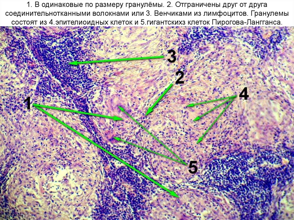 Микропрепарат лимфатический узел. Реактивная гиперплазия лимфатических узлов микропрепарат. Реактивная гиперплазия лимфоузла микропрепарат. Эпителиоидные клетки гистология. Эпителиоидные клетки гранулемы.