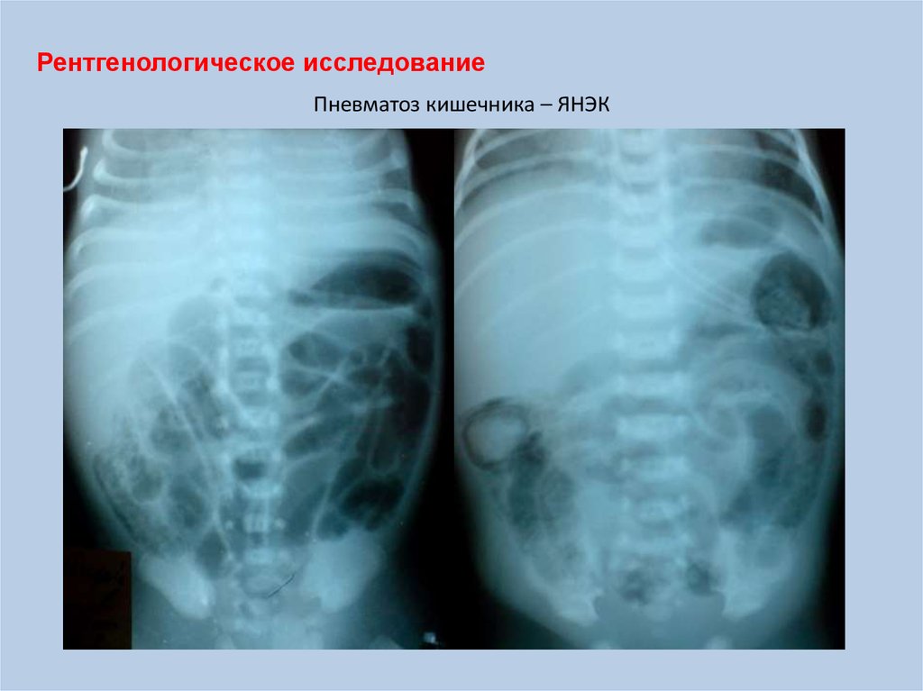 Симптомы пневматоза кишечника лечение. Пневматоз кишечника макропрепарат. Пневматоз Толстого кишечника рентген. Пневматоз ободочной кишки рентген.