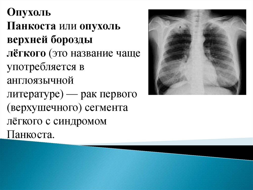 Опухоль легких. Синдром Панкоста рентген. Опухоль Панкоста рентген.