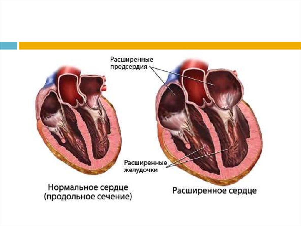 Расширение сердца. Кардиопатия сердца у детей. Расширение сердца у животных. Тонзиллогенная кардиомиопатия.