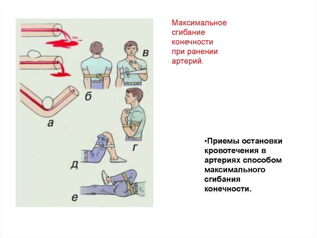 Основные способы остановки при ранении головы