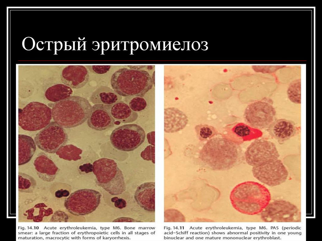 Эритромиелоз картина крови