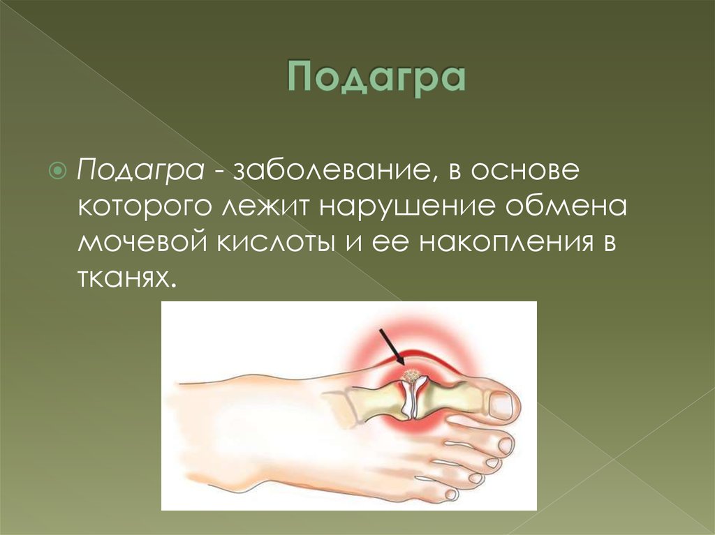 Заболевания подагра симптомы и причины