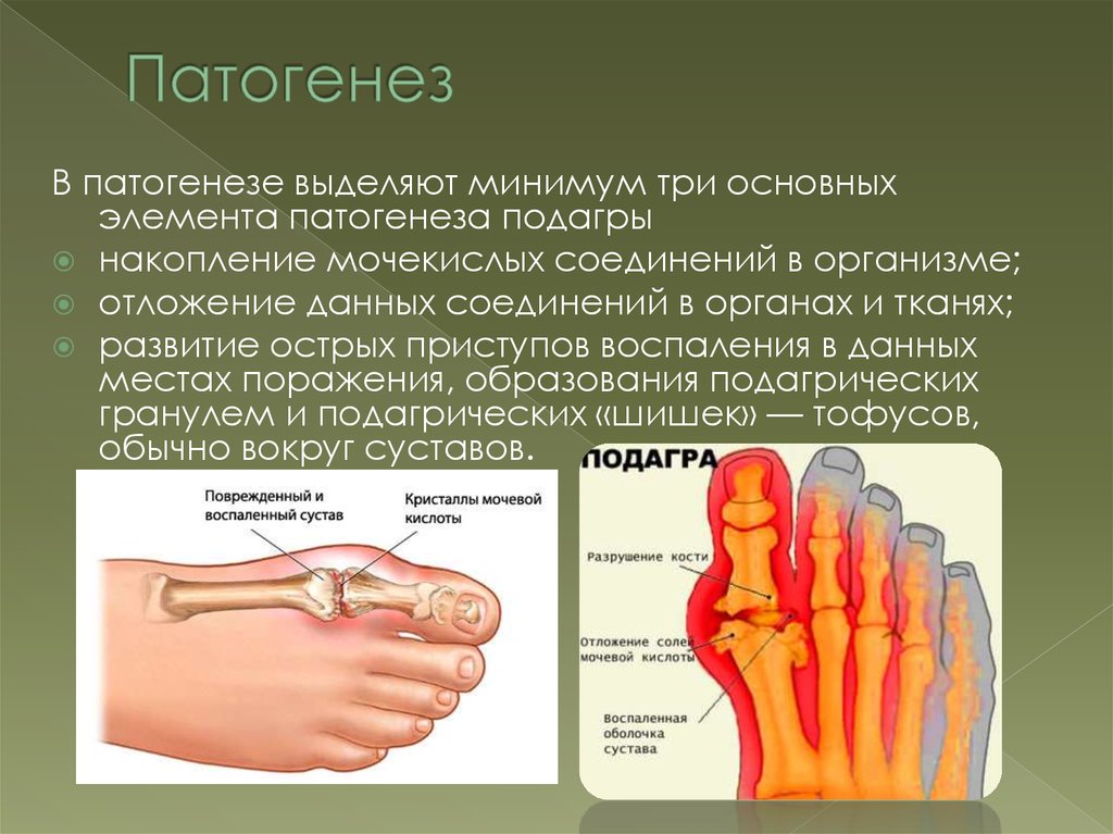 Подагра лекция презентация