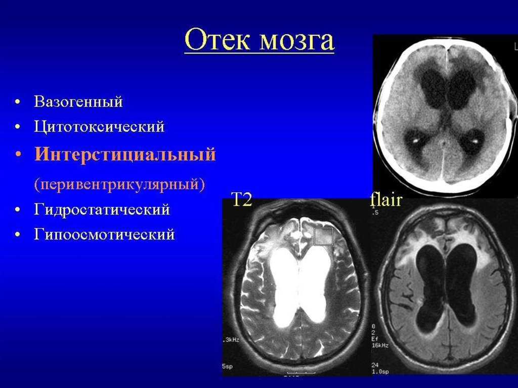 Оттек головного мозга. Цитотоксический отёк головного мозга кт. Цитотоксический отек мозга на кт. Вазогенный отек мозга на кт. Вазогенный отек головного мозга кт.