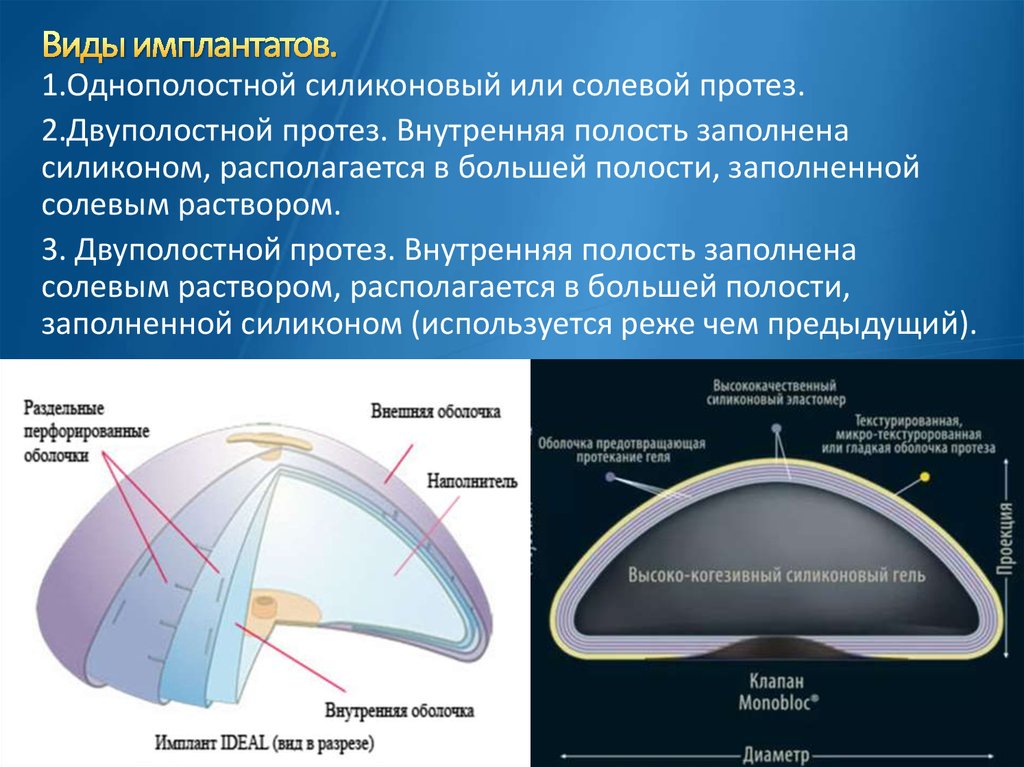 Срок годности имплантов. Виды силиконовых имплантов. Когезивный гель в имплантах. Из чего состоит имплант груди. Строение имплантов молочных желез.