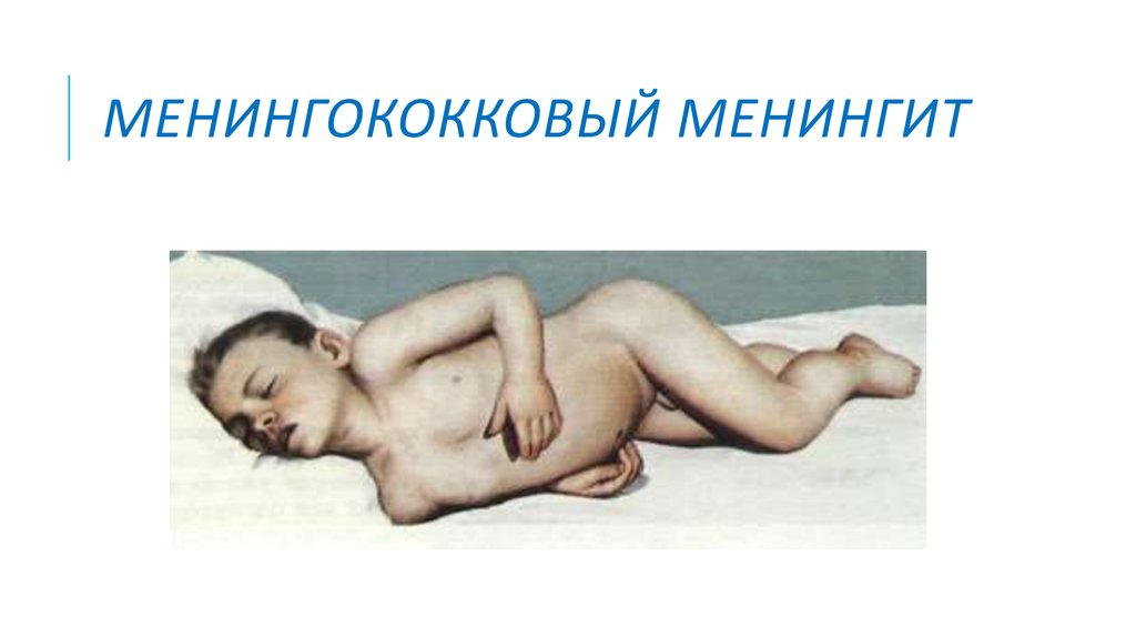 Менингококковый менингит