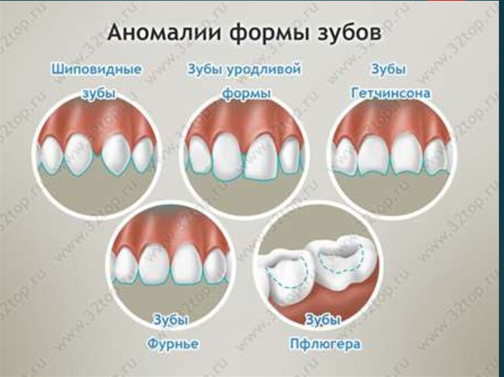 Почему зубы отличаются между собой у разных. Аномалии формы зубов зубы Гетчинсона. Аномалии формы зубов зубы Фурнье. Зубы Гетчинсона Фурнье Пфлюгера. Гипоплазия зубов зубы Гетчинсона.