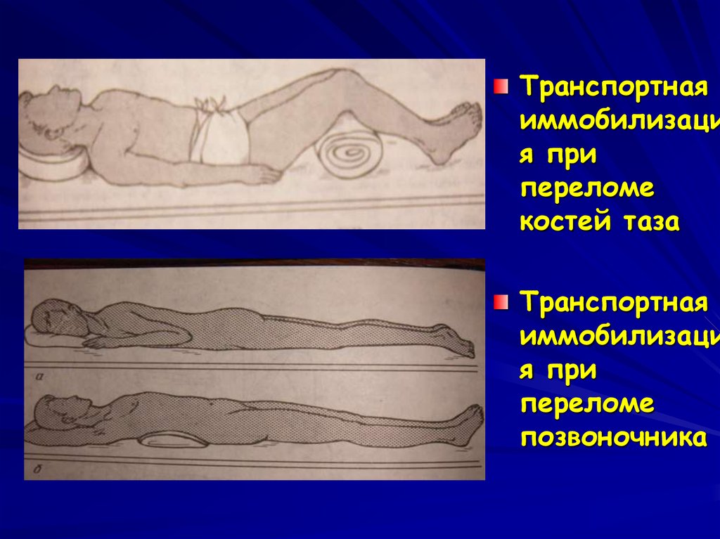 Транспортировка с переломом позвоночника каким образом. Иммобилизация при переломе позвоночника. Перелом костей таза повязка. Повязка при переломе позвоночника. Мобилизация при переломе позвоночника.