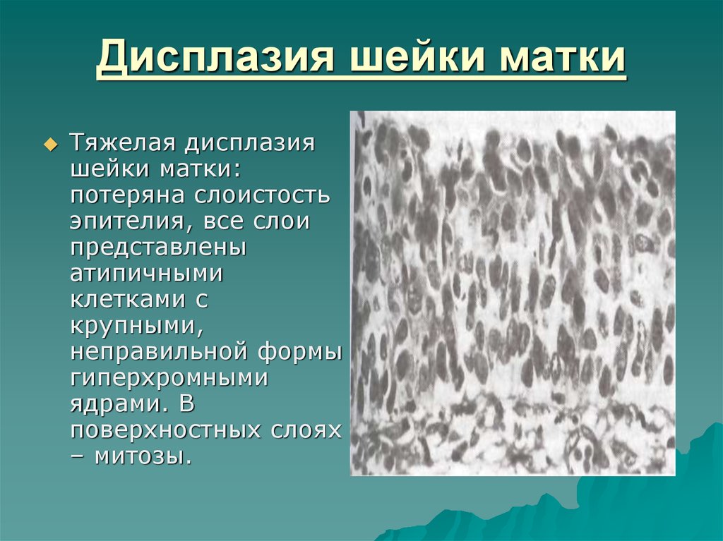 Клетки с гиперхромными ядрами. Дисплазия эпителия шейки матки. Тяжелая дисплазия эпителия шейки матки это.