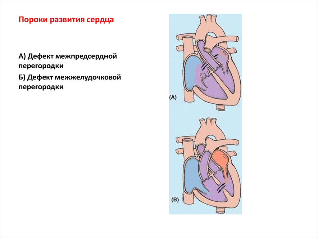 Дефект межпредсердной перегородки по утвержденным клиническим. Пороки развития сердечно сосудистой системы. Пороки развития кровеносной системы. Развитие межпредсердной перегородки.