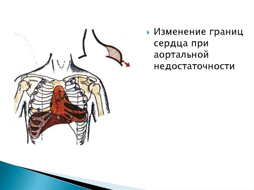 Границы сердца. Изменение границ тупости сердца. Абсолютная тупость сердца при аортальной недостаточности. Границы сердца при аортальной недостаточности. При аортальной недостаточности изменяются границы сердца.