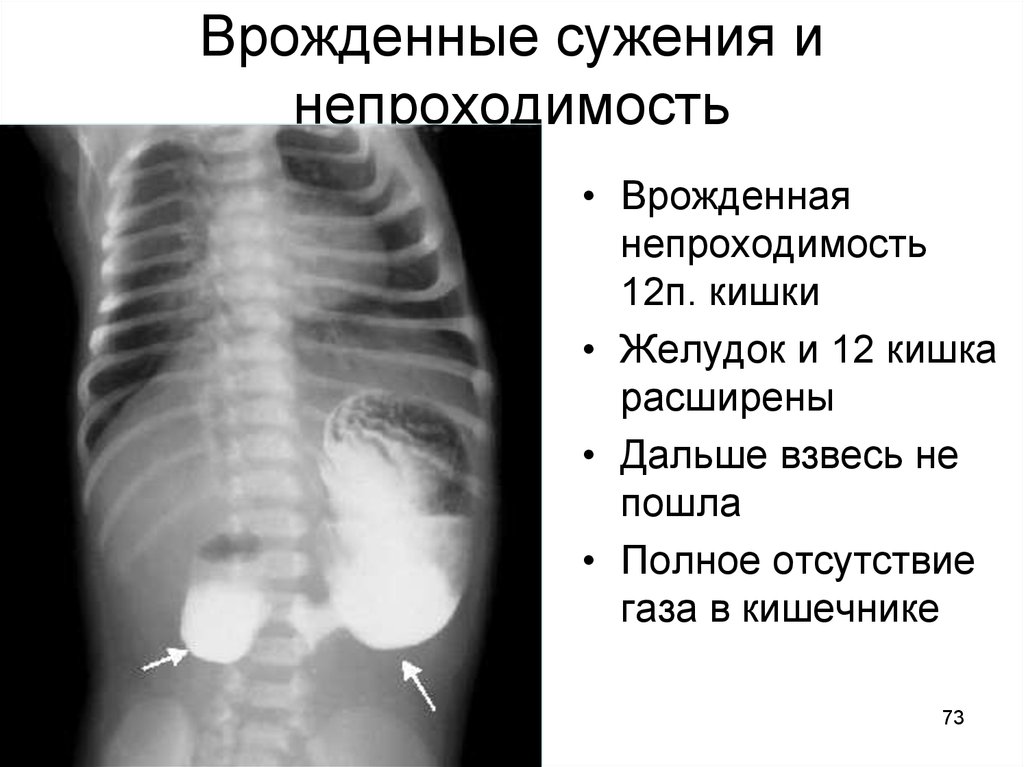 Кишечные каналы. Врожденные сужения прямой кишки. Сужение дуги 12п кишки рентген.