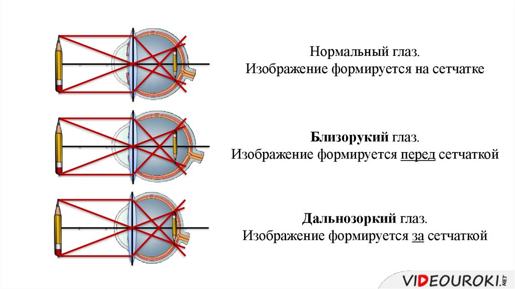 Нормальный глаз формирует изображение