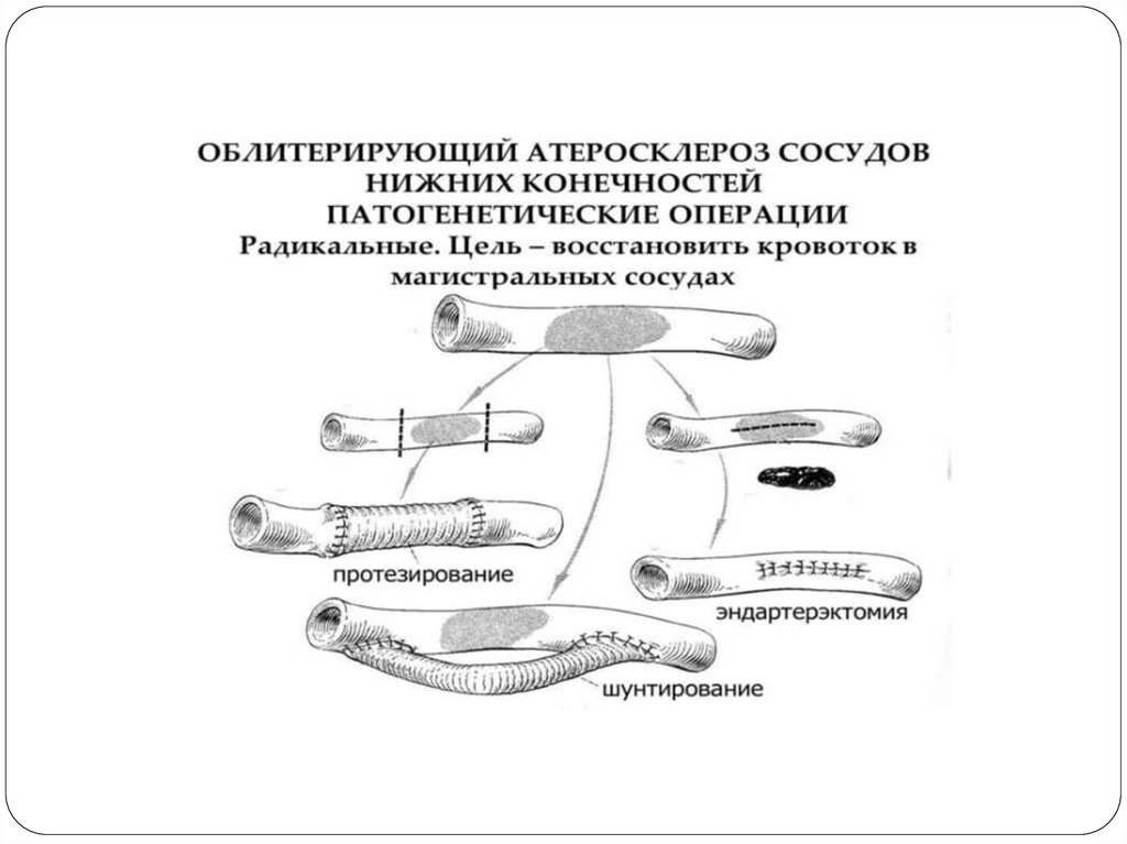 Операция на сосудах нижних конечностей. Протезирование сосудов. Протезирование артерий. Протезирование сосудов нижних конечностей.