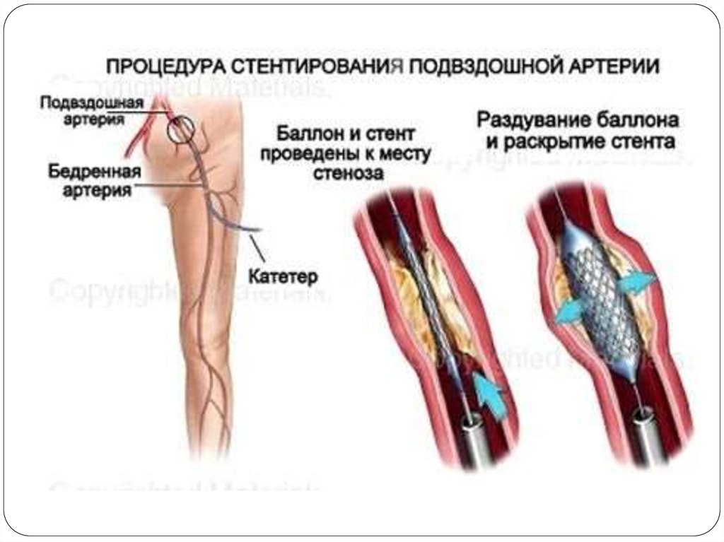 Шунтирование артерий нижних конечностей