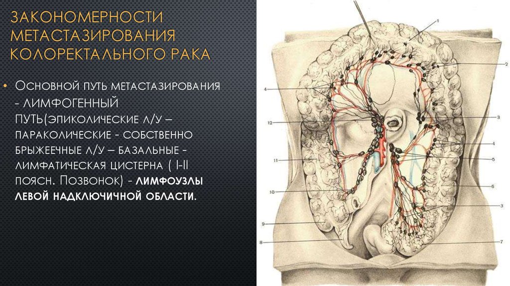 Метастазы при колоректальном раке. Верхние брыжеечные лимфоузлы. Мезентериальные лимфатические узлы. Закономерности метастазирования.