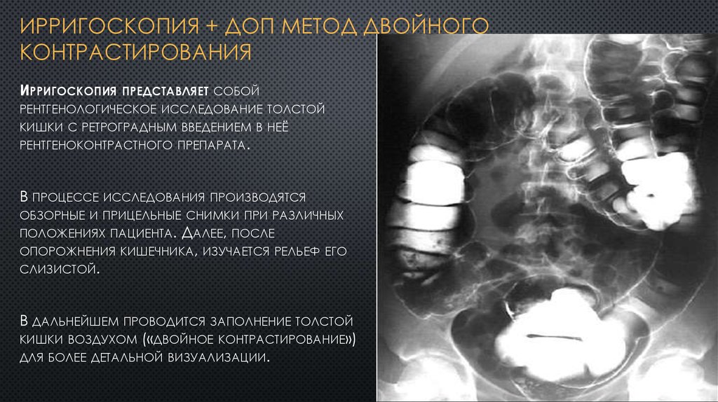 Ирригоскопия это рентгенологическое контрастное исследование. Двойное контрастирование толстой кишки. Ирригоскопия фаза двойного контрастирования. Ирригоскопия двойное контрастирование. Методика ирригоскопии.