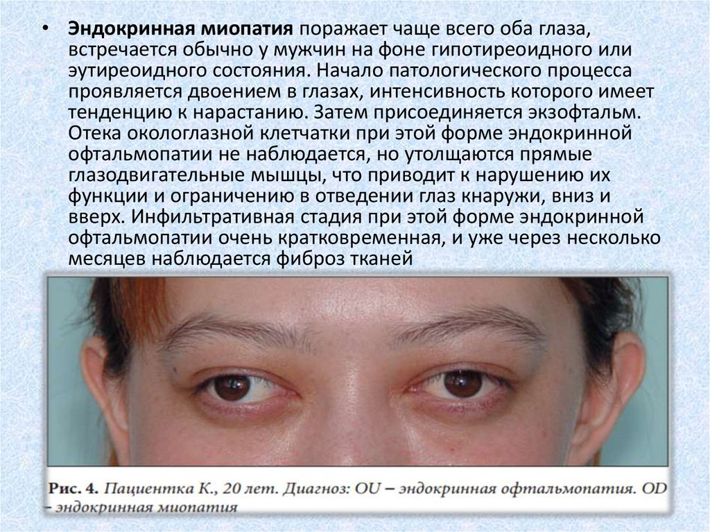 Миопатия глаза что это