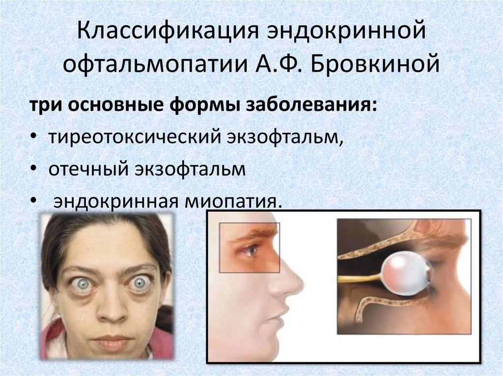 Экзофтальм наблюдается при. Эндокринная офтальмопатия глазные симптомы. Классификация CAS эндокринная офтальмопатия. Тиреотоксикоз офтальмопатия эндокринная. Классификация nospecs эндокринной офтальмопатии.