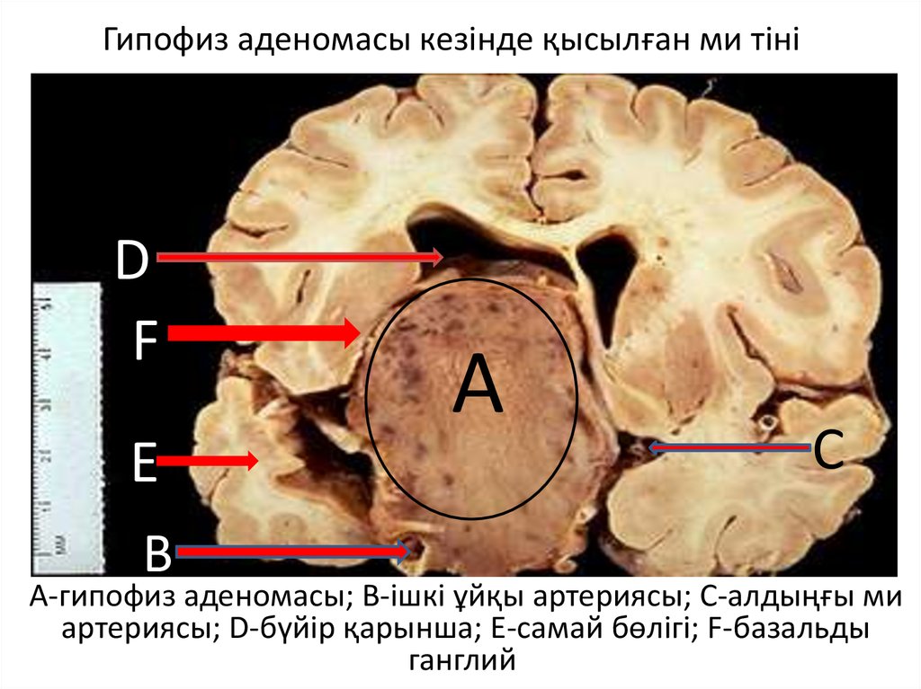 Аденома гипофиз мозга что это такое. Эндосупраселлярная аденома гипофиза. Хромофобная аденома гипофиза клиника. Аденома гипофиза расположение. Микроаденома головного мозга.
