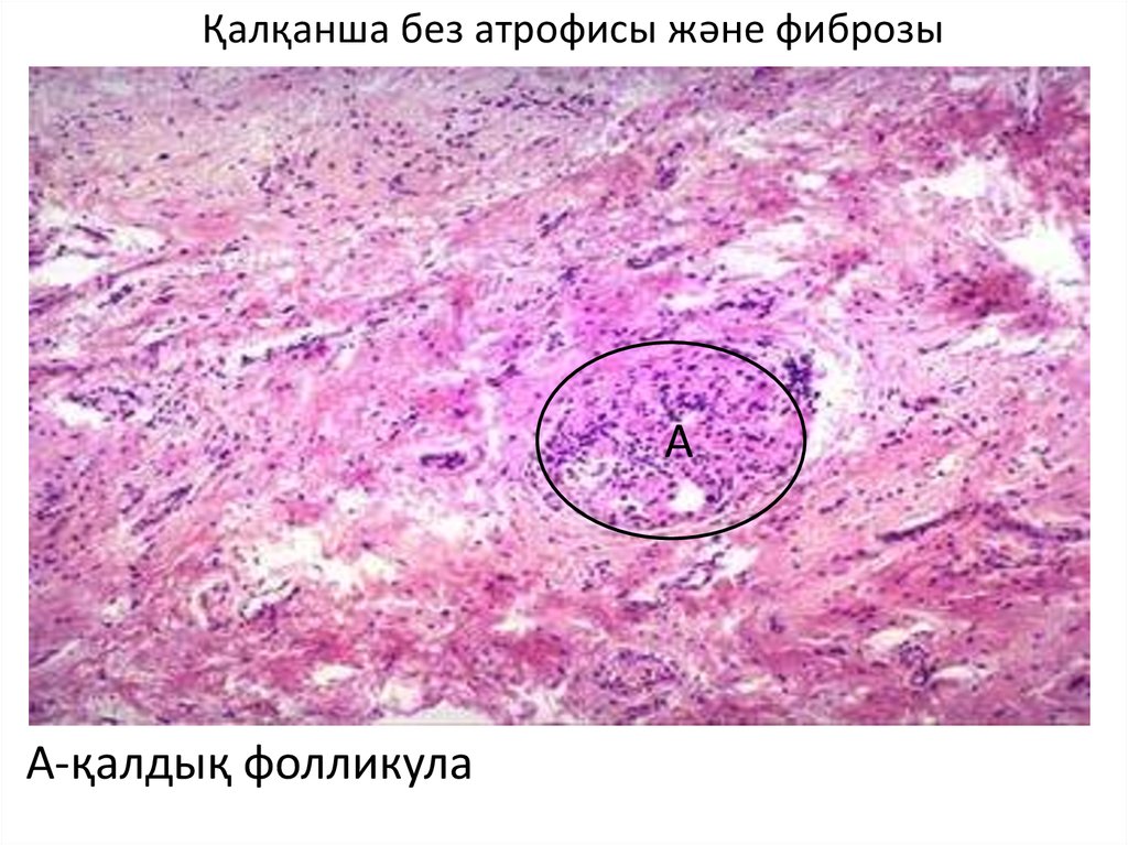 Фиброз желез. Туберкулез щитовидной железы макропрепарат. Атрофия щитовидной железы. Фиброз щитовидной железы. Фиброз в щитовидной железе.