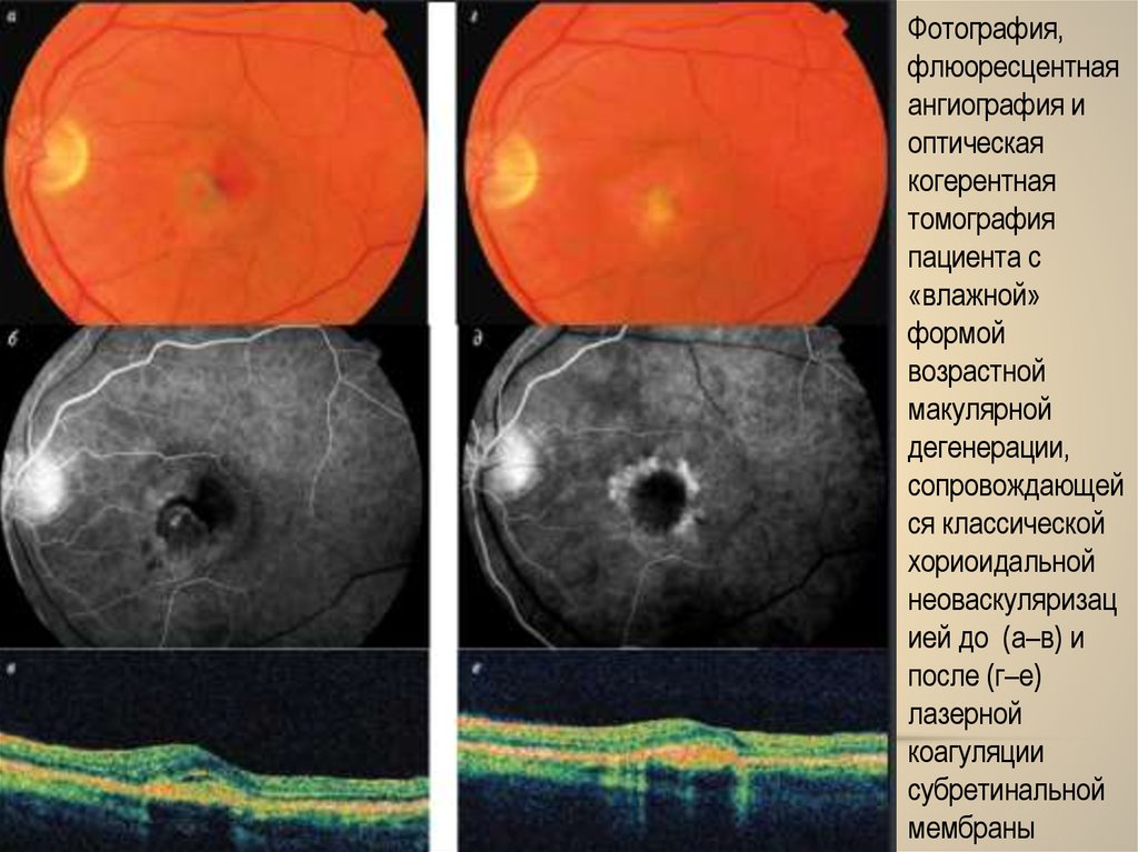 Периферические ретинальные дегенерации. Возрастная макулярная дегенерация сетчатки. Макулярная дегенерация сетчатки симптомы. Макулодистрофия на окт сетчатки. Макулодистрофия сетчатки сухая форма.