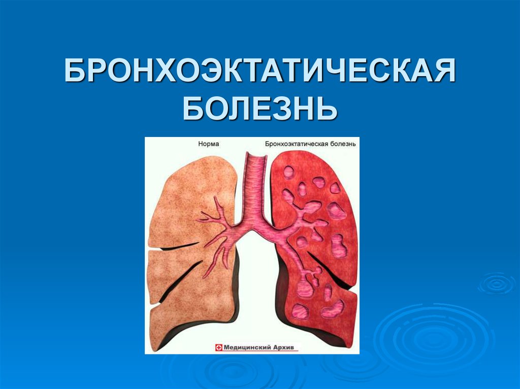 Бронхоэктатическая болезнь презентация