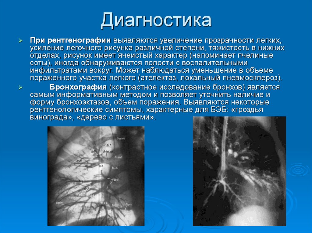 Отделы легочного рисунка. Тяжистость легочного рисунка в нижних отделах. Усиление легочной прозрачности. Увеличение легочного рисунка.