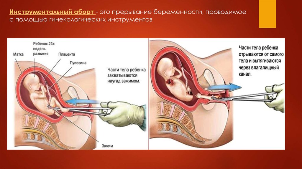 Инструментальный аборт - это прерывание беременности, проводимое с помощью гинекологических инструментов