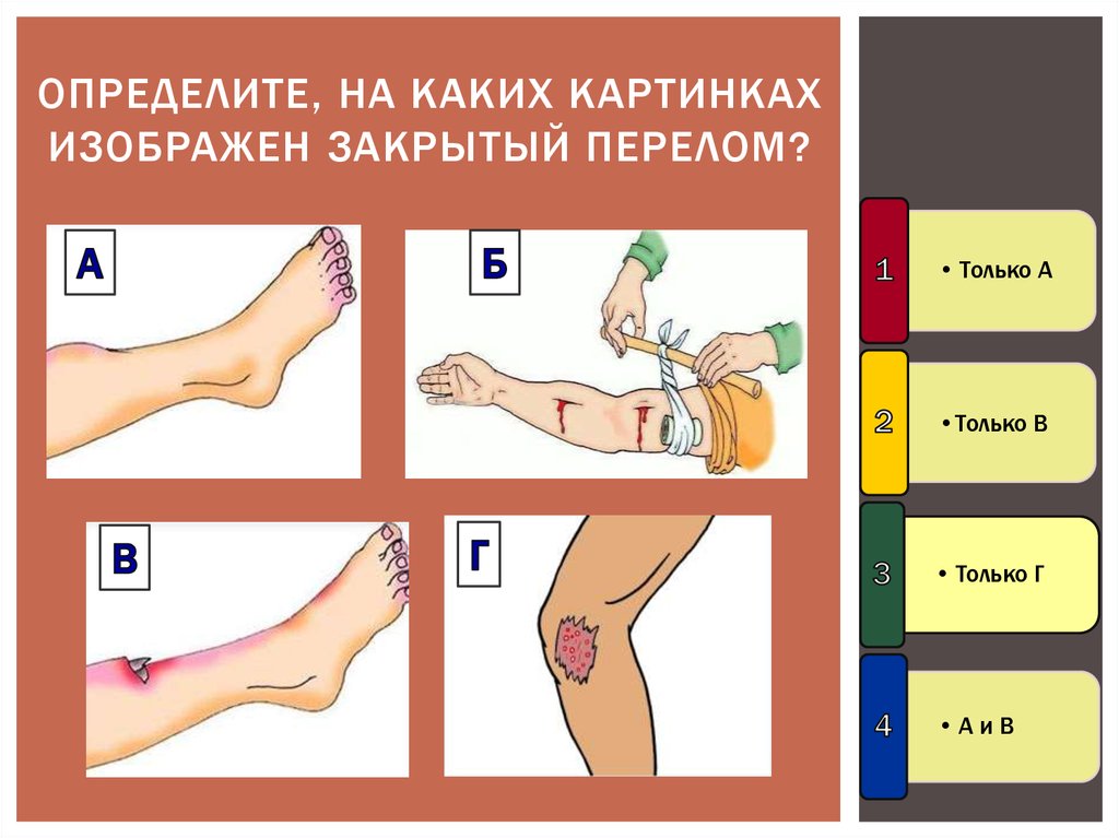 Изображать закрывать. На какой картинке изображён закрытый перелом. Определите, на каких картинках изображен закрытый перелом?. Укажите на каких рисунках изображены закрытый перелом.