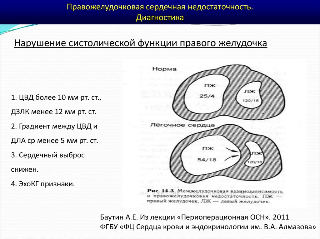 Патогенез правожелудочковой недостаточности