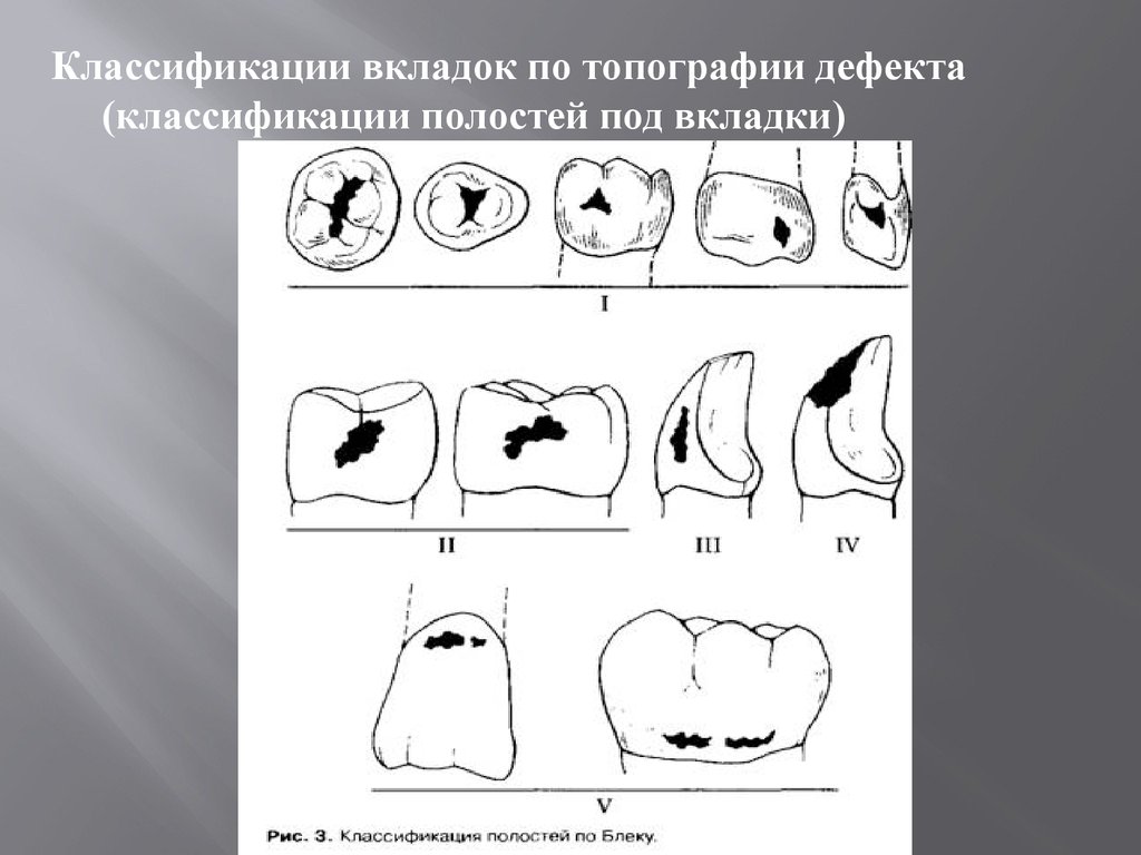 Классификация полостей. Классификация вкладок в ортопедической стоматологии. Классификация вкладок по топографии дефекта. Вкладки стоматология классификация. Классификация полостей под вкладки.