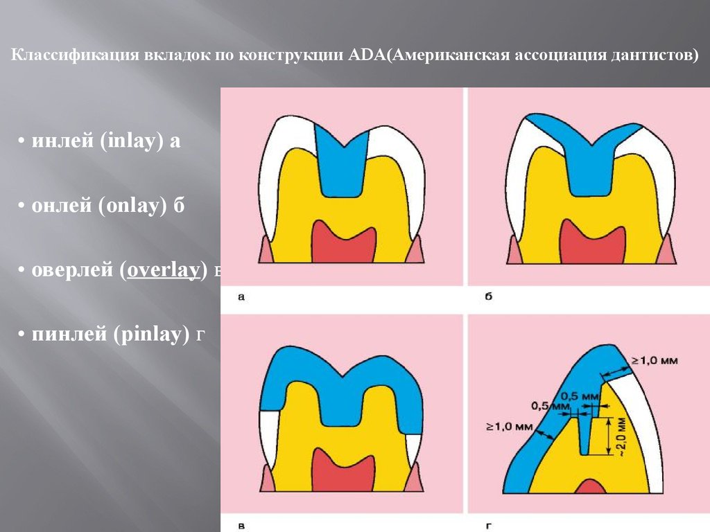 Презентация зубные вкладки