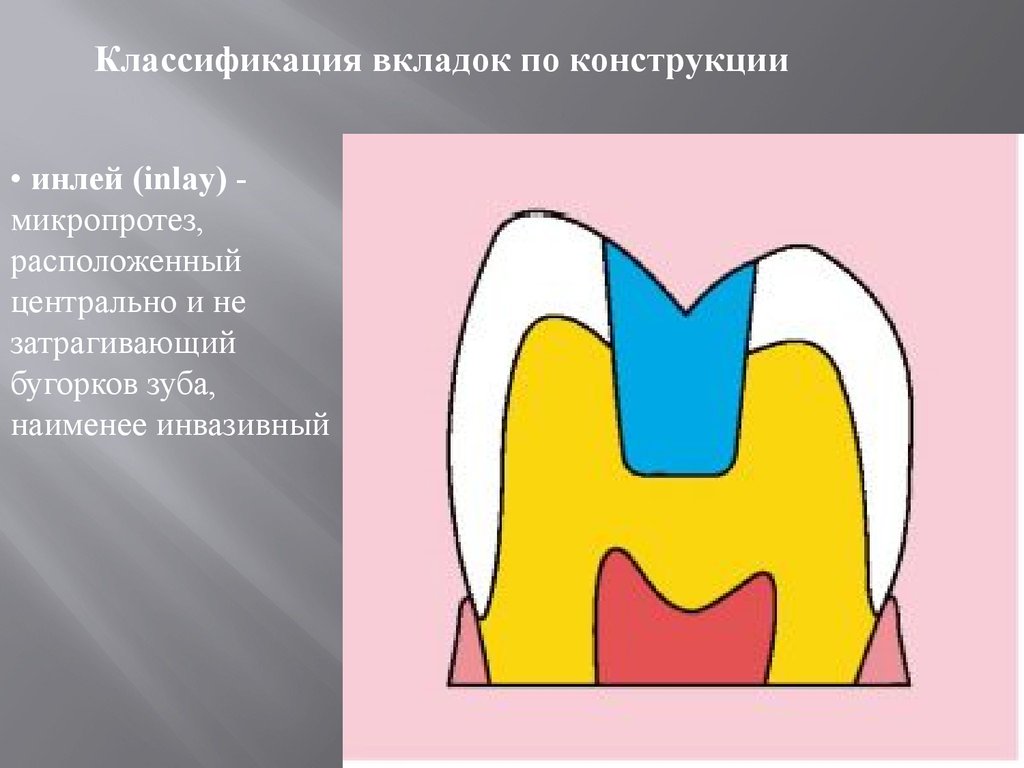 Виды вкладок. Препарирование под вкладку Инлей. Классификация вкладок по конструкции. Вкладки стоматология классификация.