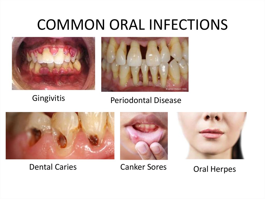infection in mouth
