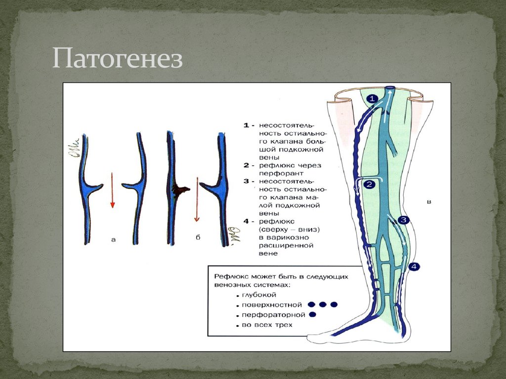БПВ Вена остиальный клапан. Клапаны большой подкожной вены. Остиальный клапан анатомия. Несостоятельность остиального клапана большой подкожной.