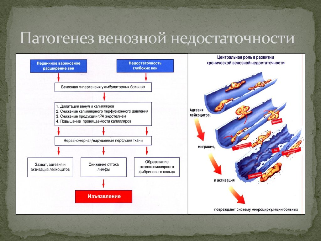 Недостаточность клапанов нижних конечностей