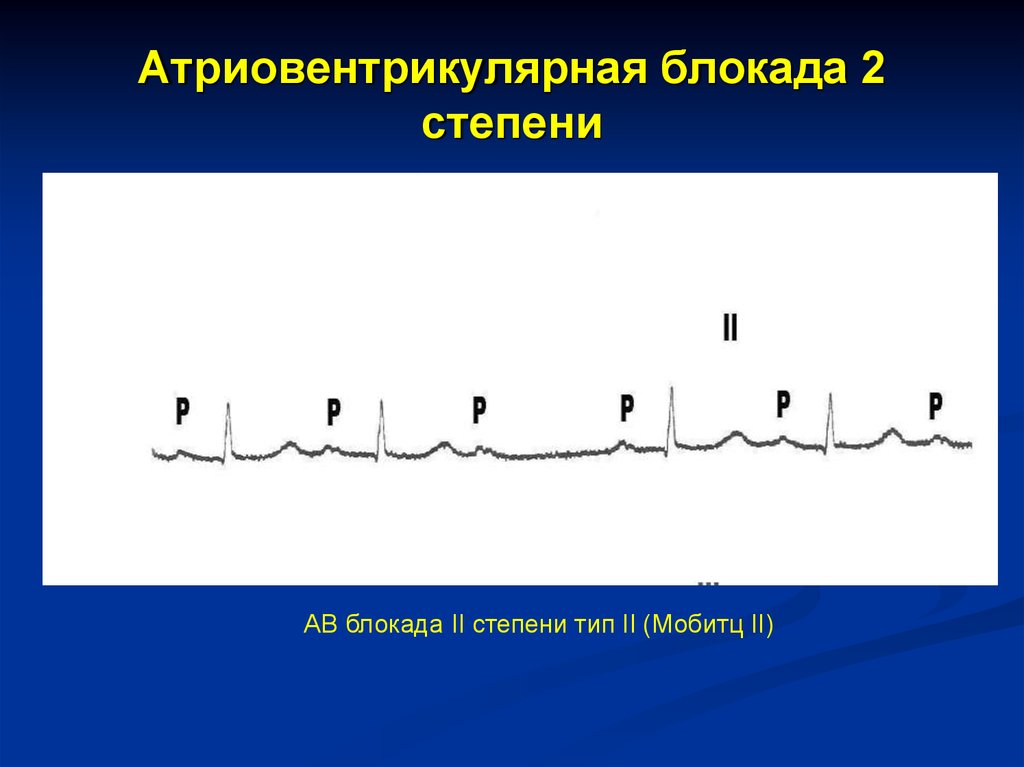 Ав блокада 2 степени