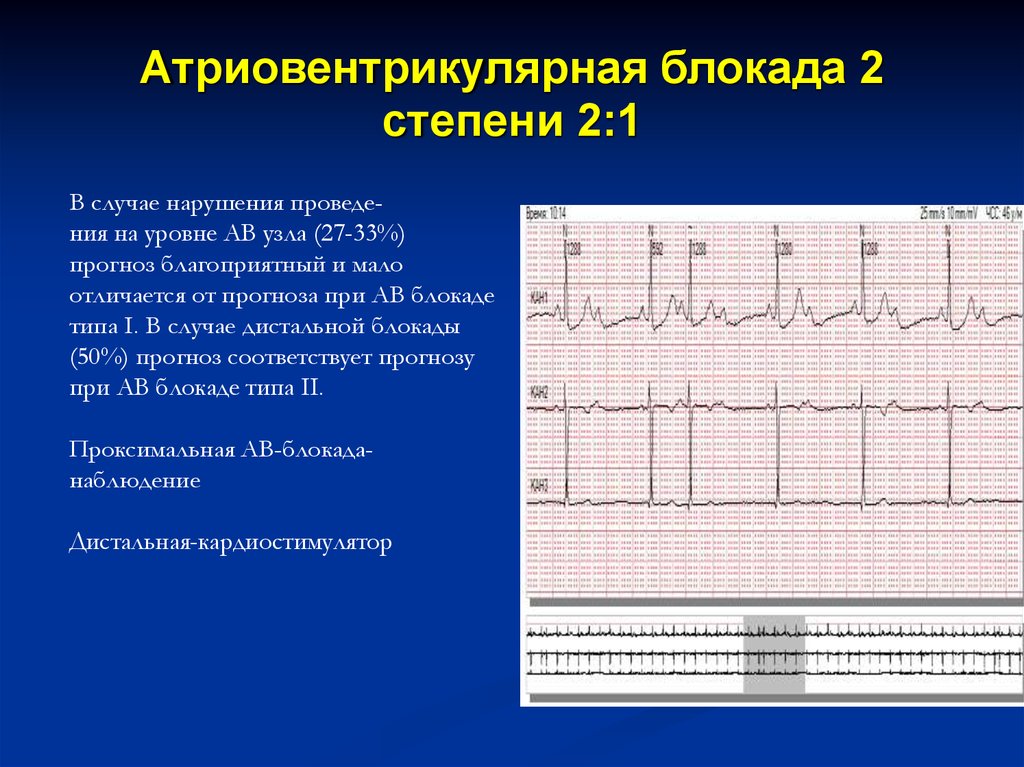 Ав блокада 2 степени