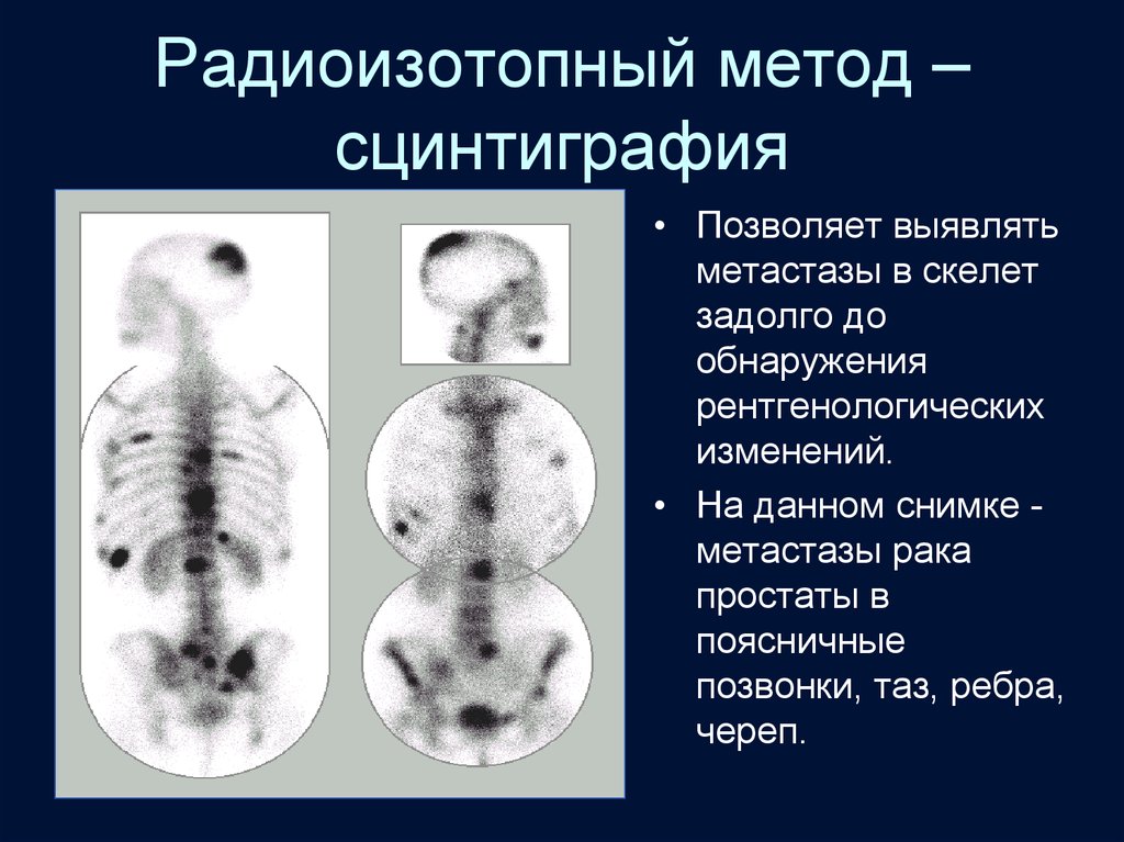 Сцинтиграфия скелета. Радиоизотопное исследование костей. Радиоизотопная сцинтиграфия костей скелета. Сцинтиграфия костей метастазы.