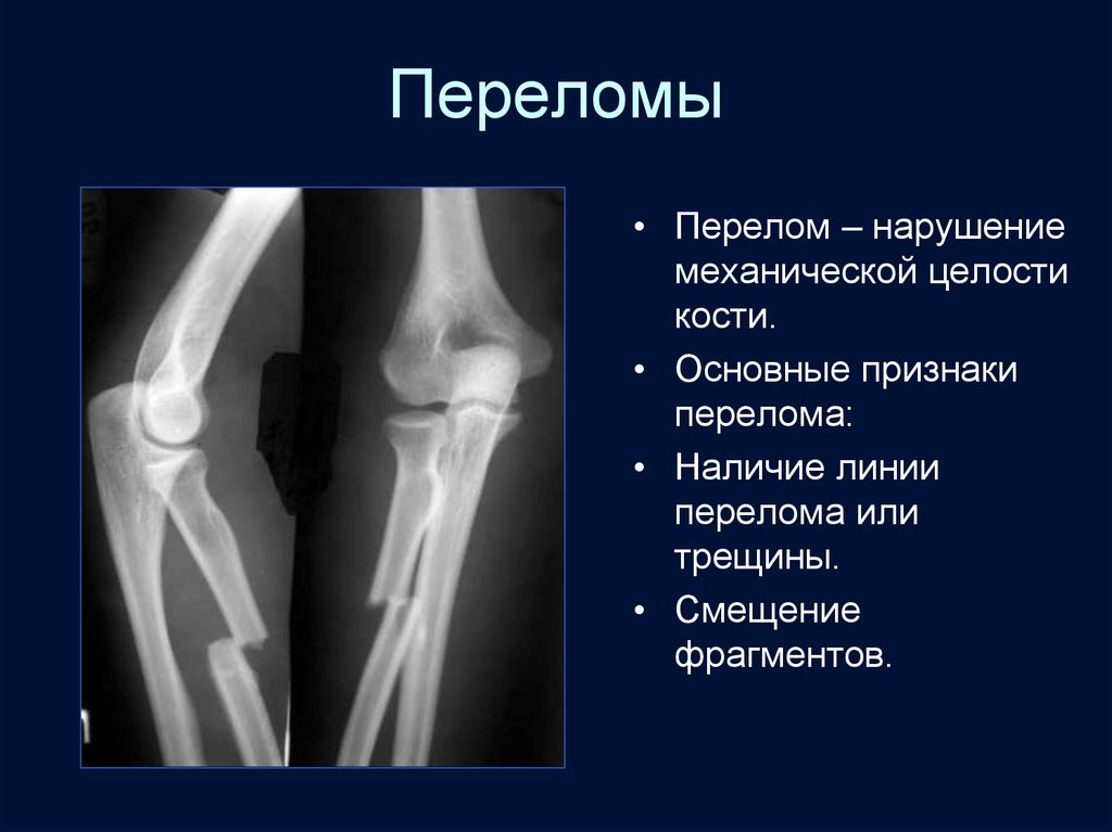 Рентгеновская картина переломов и вывихов костей